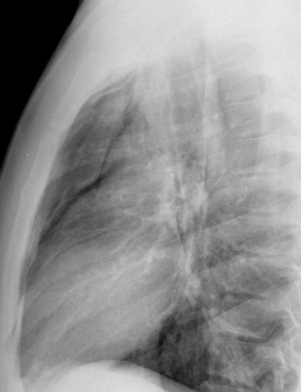 Pneumomediastinum 2 lat