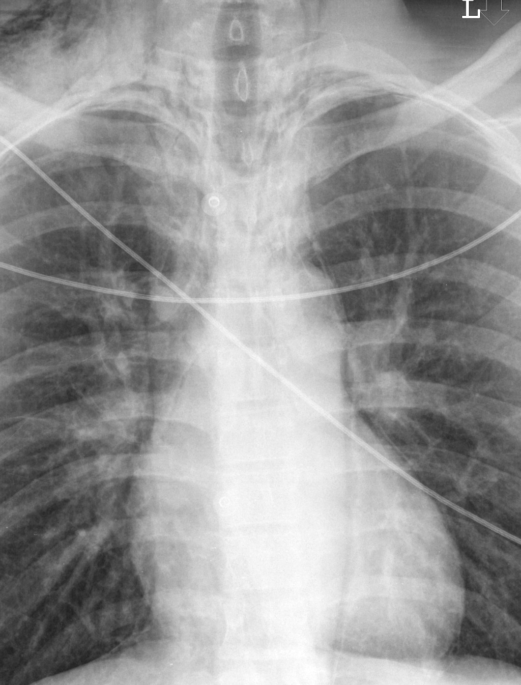 Pneumomediastinum 3