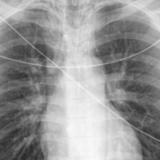 Pneumomediastinum 3