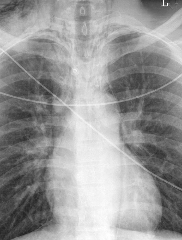 Pneumomediastinum 3