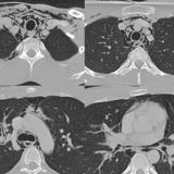 Pneumomediastinum 3 CT