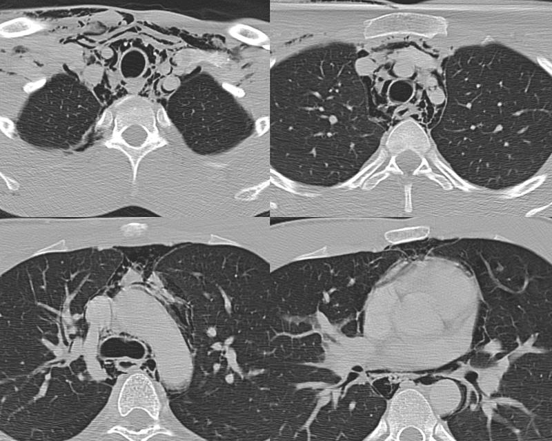 Pneumomediastinum 3 CT