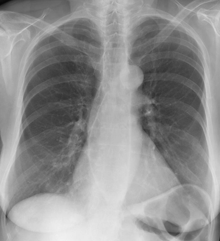 Scleroderma esophagus