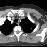 normal axillary node