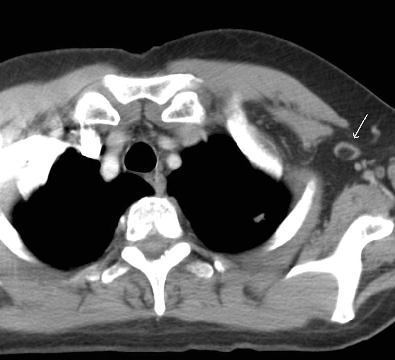 normal axillary node