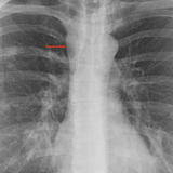 Foregut cyst
(and RML pneumonia)