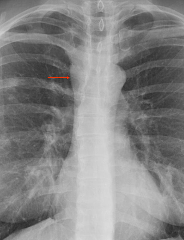 Foregut cyst
(and RML pneumonia)