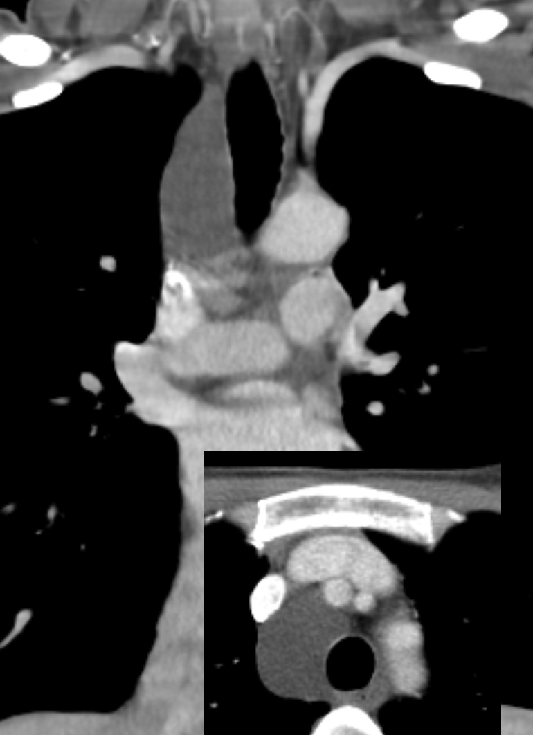 Foregut cyst CT