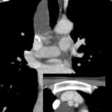 Foregut cyst CT