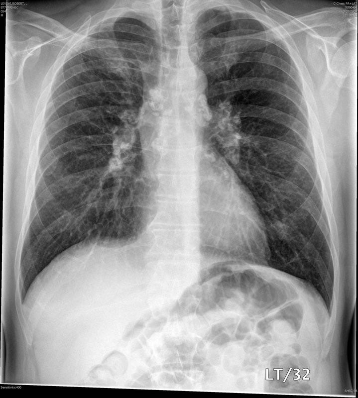 node calcification