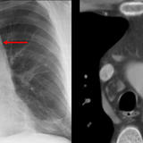 mediastinal fat