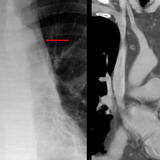 mediast fat Coronal CT