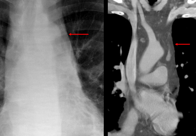 mediast fat Coronal CT