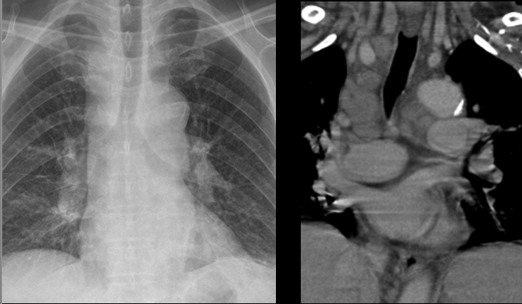 Mediastinal adenopathy