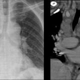 Mediastinal adenopathy