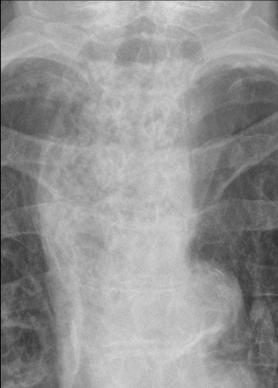 same patient- distended esop