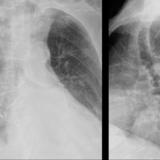 Dilated esophagus- Pa and lat from different dates