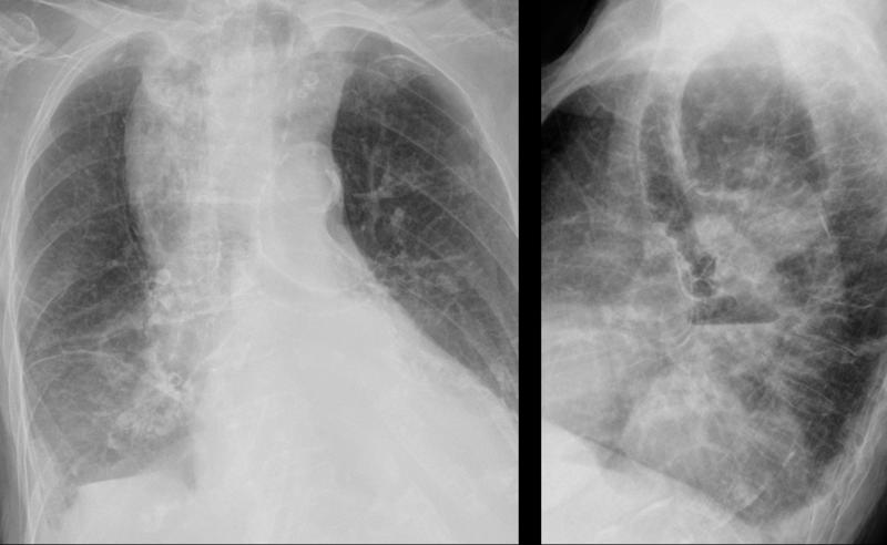 Dilated esophagus- Pa and lat from different dates