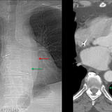 paraspinal "lines"