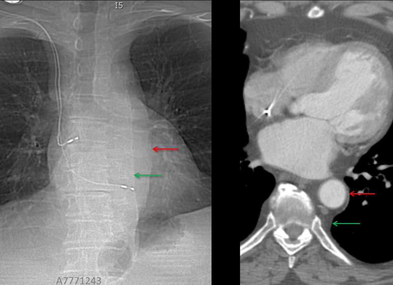 paraspinal "lines"