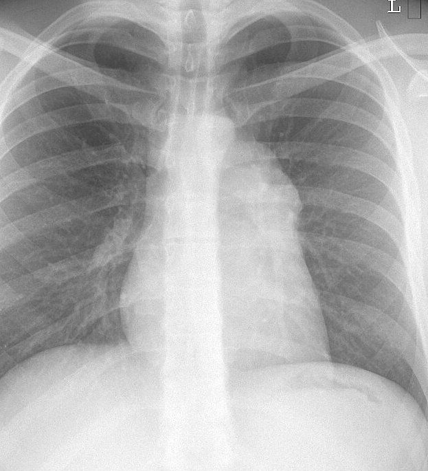 Case 1a
Thymoma