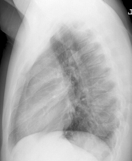 Case 1b
Thymoma