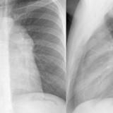 Case 1c
Thymoma