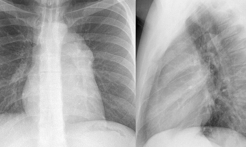 Case 1c
Thymoma