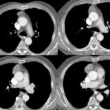 Case 2
Thymoma