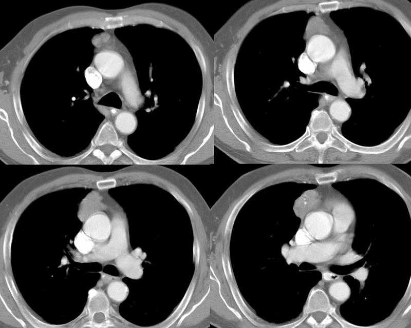 Case 2
Thymoma