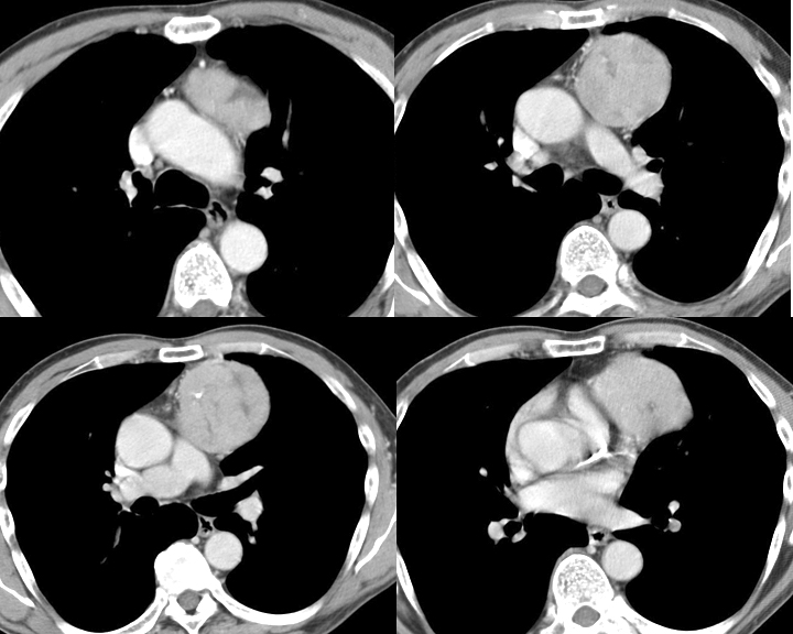 Case 4
Thymoma