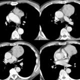 Case 4
Thymoma