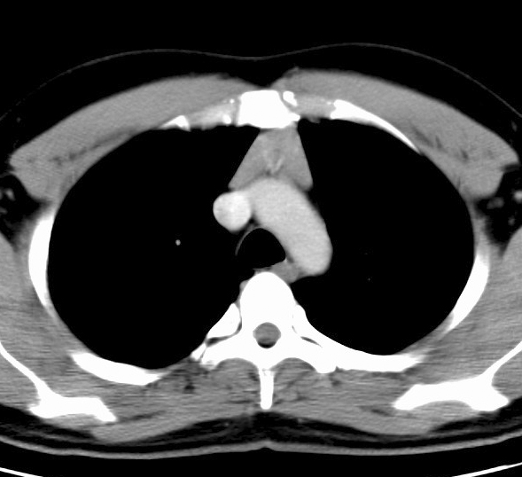 Case 5
Thymic hyperplasia