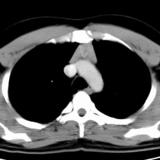 Case 5
Thymic hyperplasia