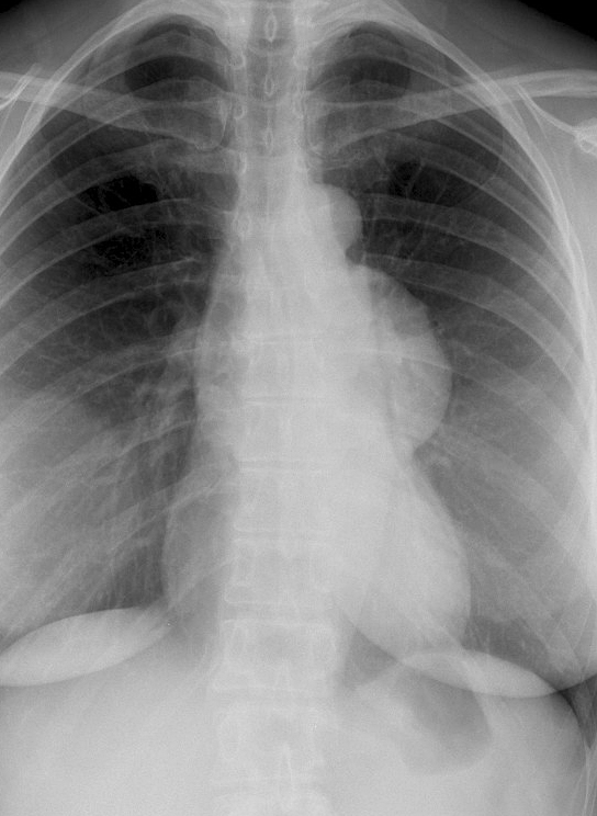 Case 6a
Thymoma