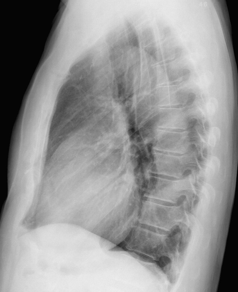 Ao Aneurysm 5b