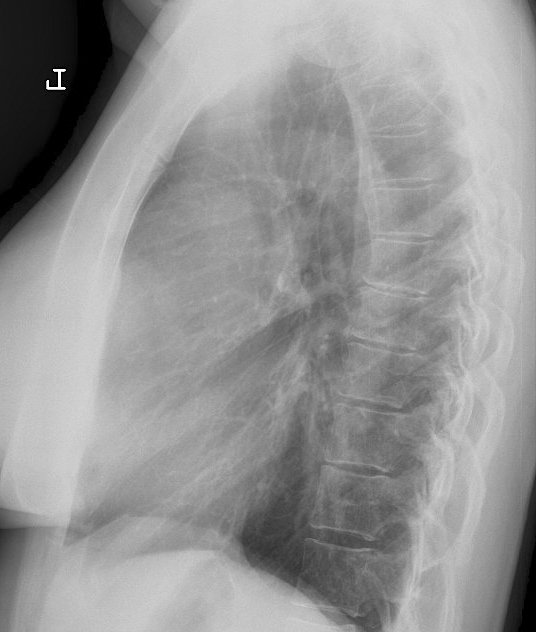 Case 6b
Thymoma