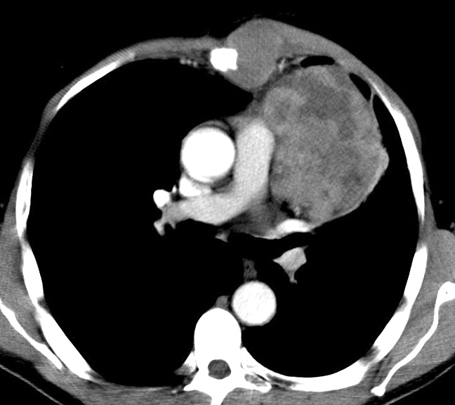 Case 7c
Malig Thymoma