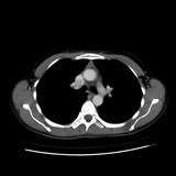 Normal Thymus