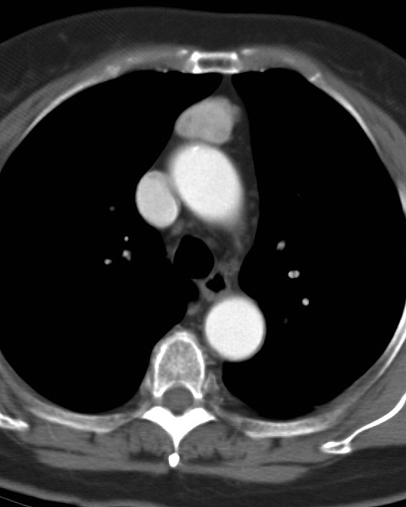 Case 8c Thymoma CT