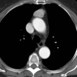 Case 8c Thymoma CT