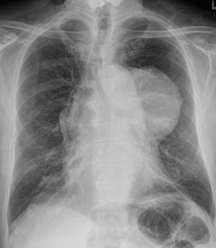 Case 9 Thymoma PA