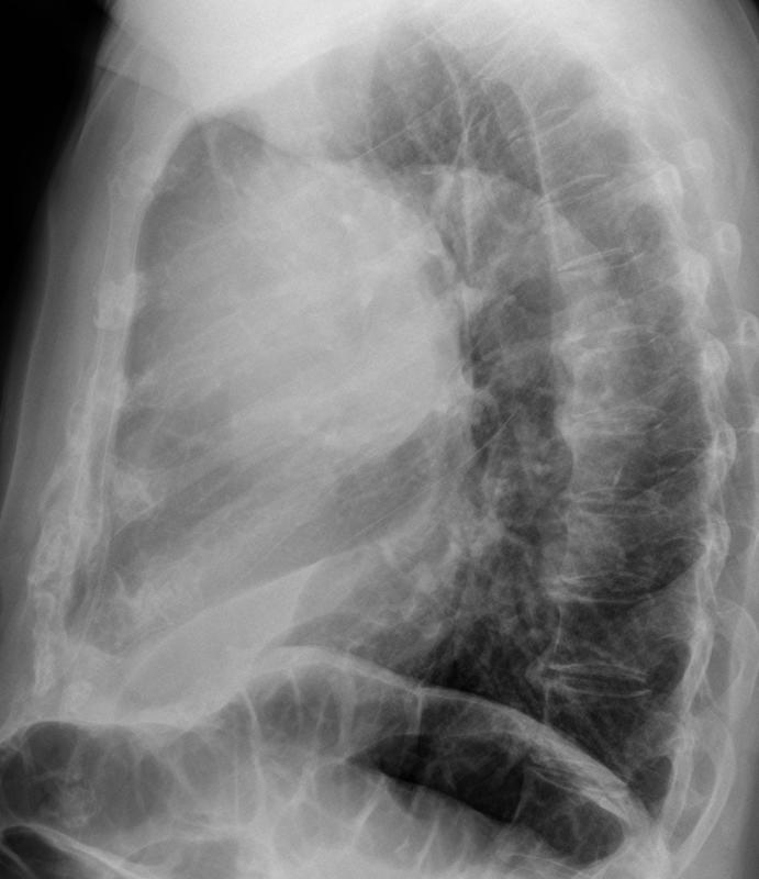 Case 9 Thymoma Lat