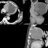 Case 9 Thymoma CT