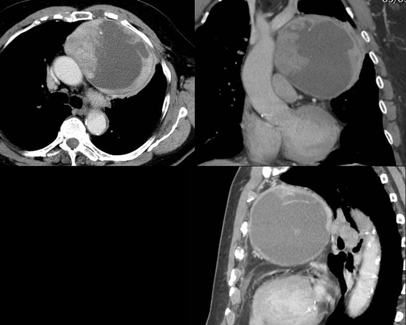 Case 9 Thymoma CT