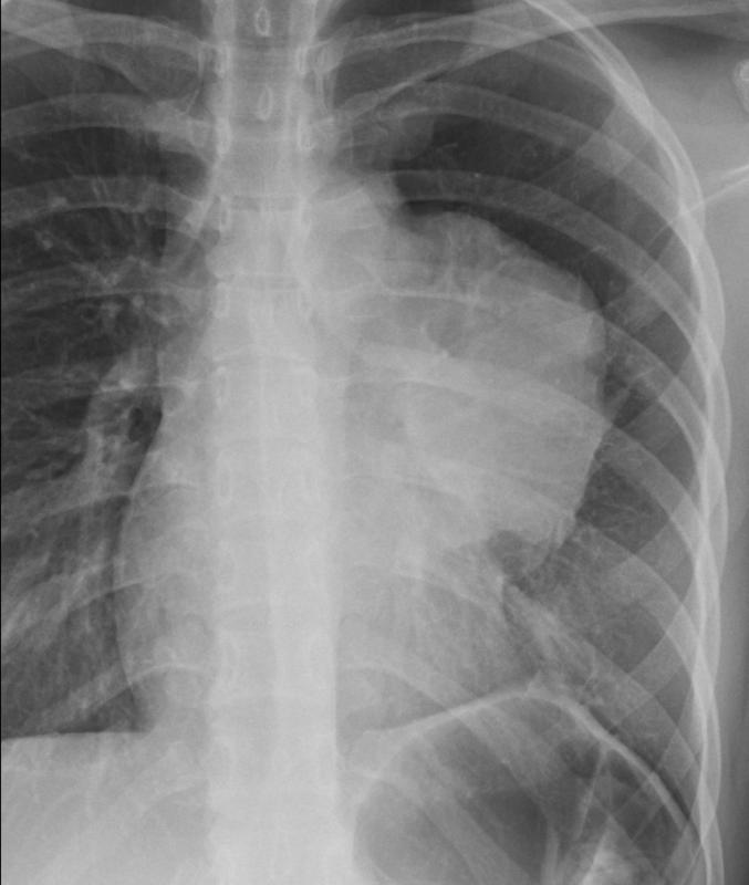 Thymic carcinoma PA