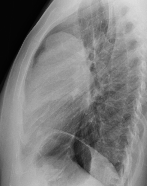 Thymic carcinoma Lat