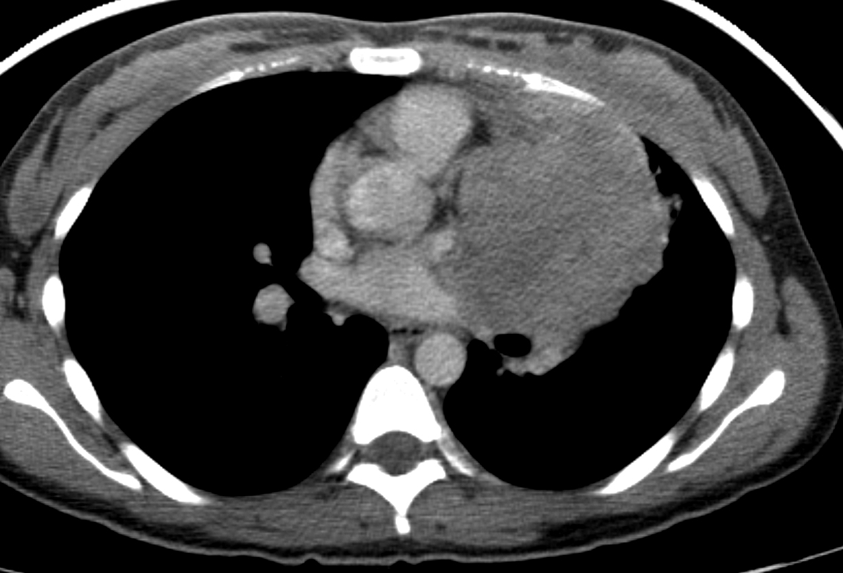 Thymic carcinoma CT