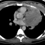 Thymic carcinoma CT