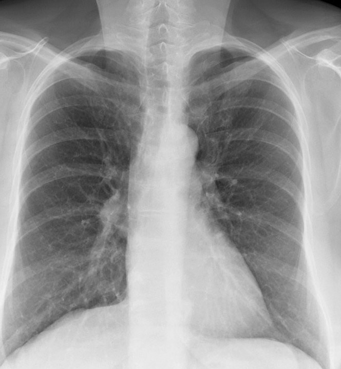 Thyroid Mass
Case 1 PA